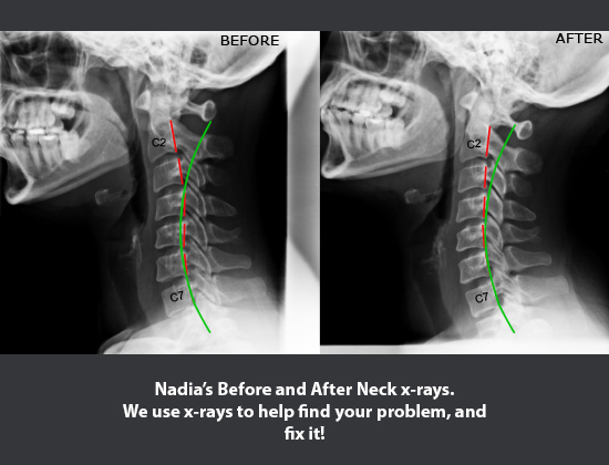 Before and after neck X-rays showing an improved neck curve after corrective chiropractic care at Align